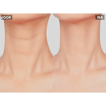 MicroLift Pro voor en na wangen – vollere en strakkere huid – ElleCera