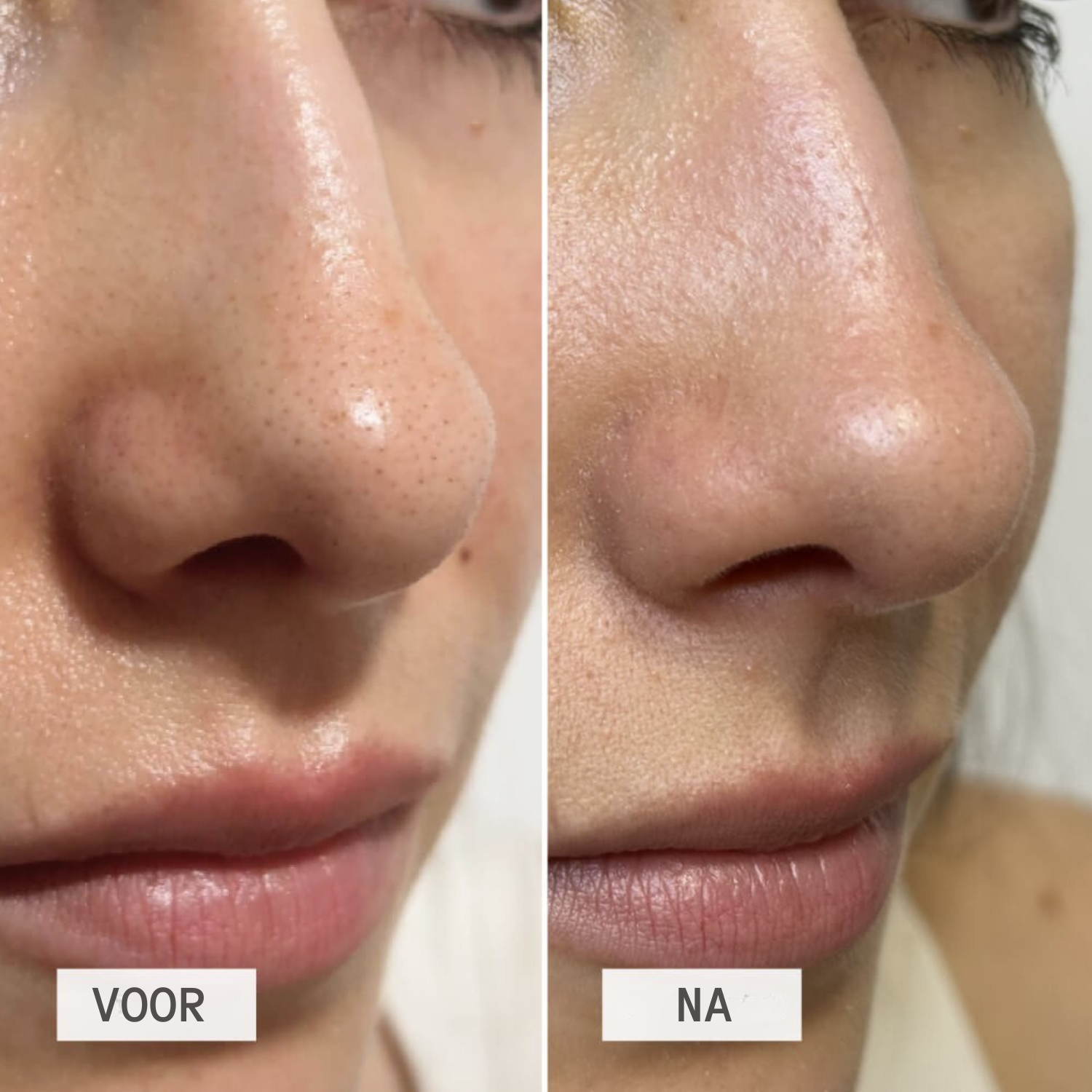 DetoxPatch werking – trekt olie en vuil uit de poriën – ElleCera