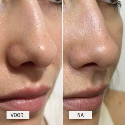 DetoxPatch werking – trekt olie en vuil uit de poriën – ElleCera