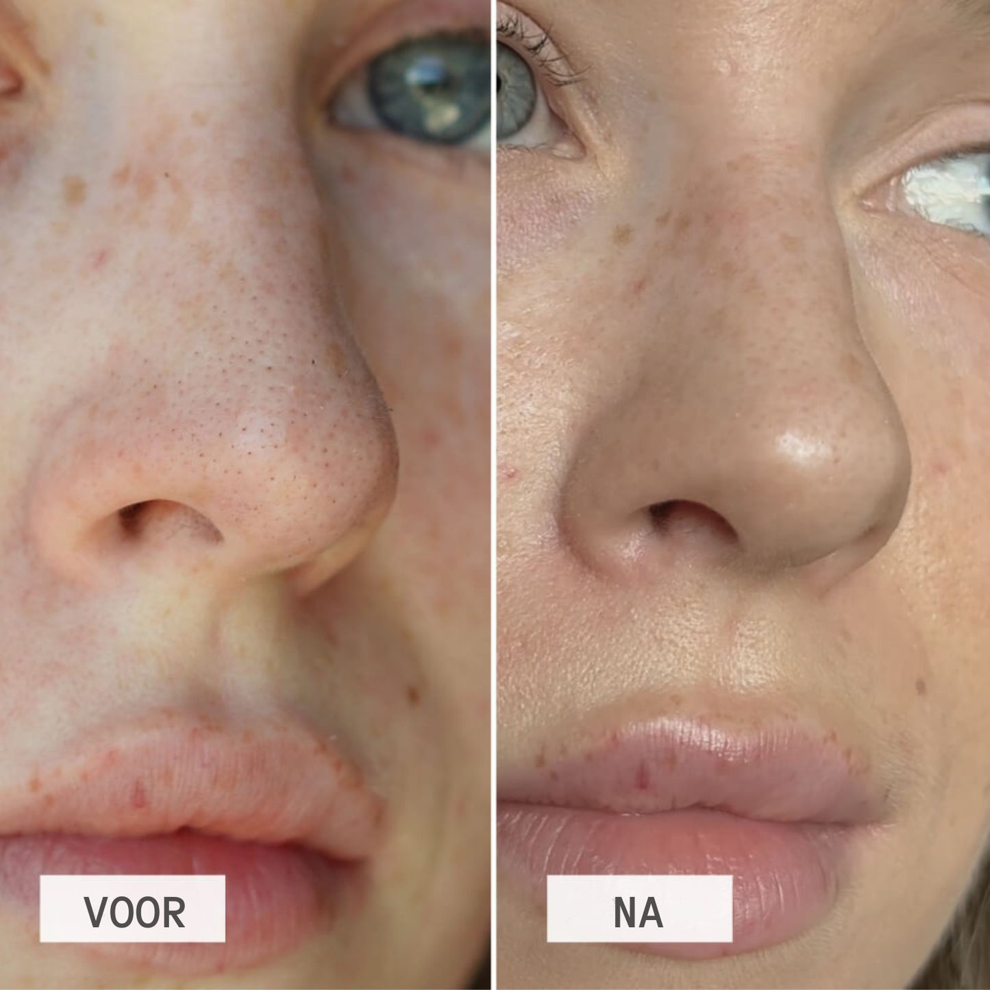 DetoxPatch voor en na – zichtbaar minder mee-eters op de neus – ElleCera