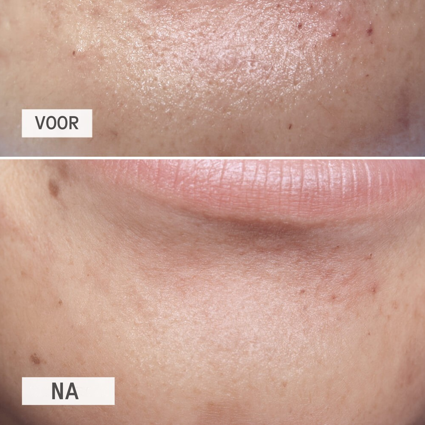 DetoxPatch voordelen – poriën zuiveren zonder uitknijpen – ElleCera