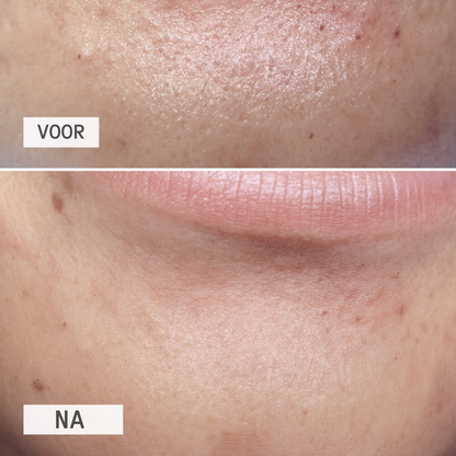 DetoxPatch voordelen – poriën zuiveren zonder uitknijpen – ElleCera
