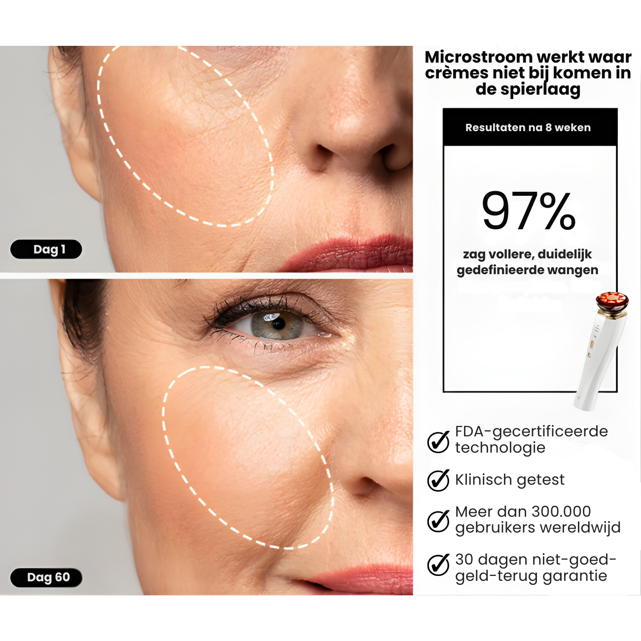MicroLift Pro voor en na – zichtbaar strakkere kaaklijn thuis – ElleCera