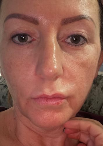 Klantreview microneedling thuis – dagelijks gebruik Micro-Infusion – ElleCera