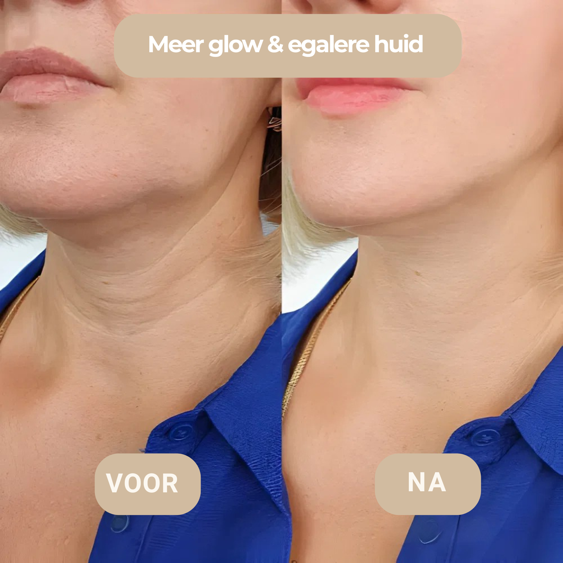 Microneedling voor en na gezicht – minder fijne lijntjes en gladdere huid thuis – ElleCera
