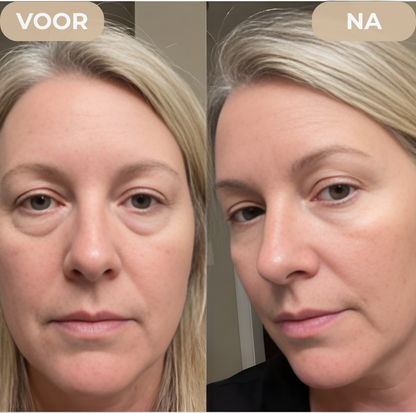 Collageen oogpatches voor en na – minder wallen en donkere kringen – ElleCera